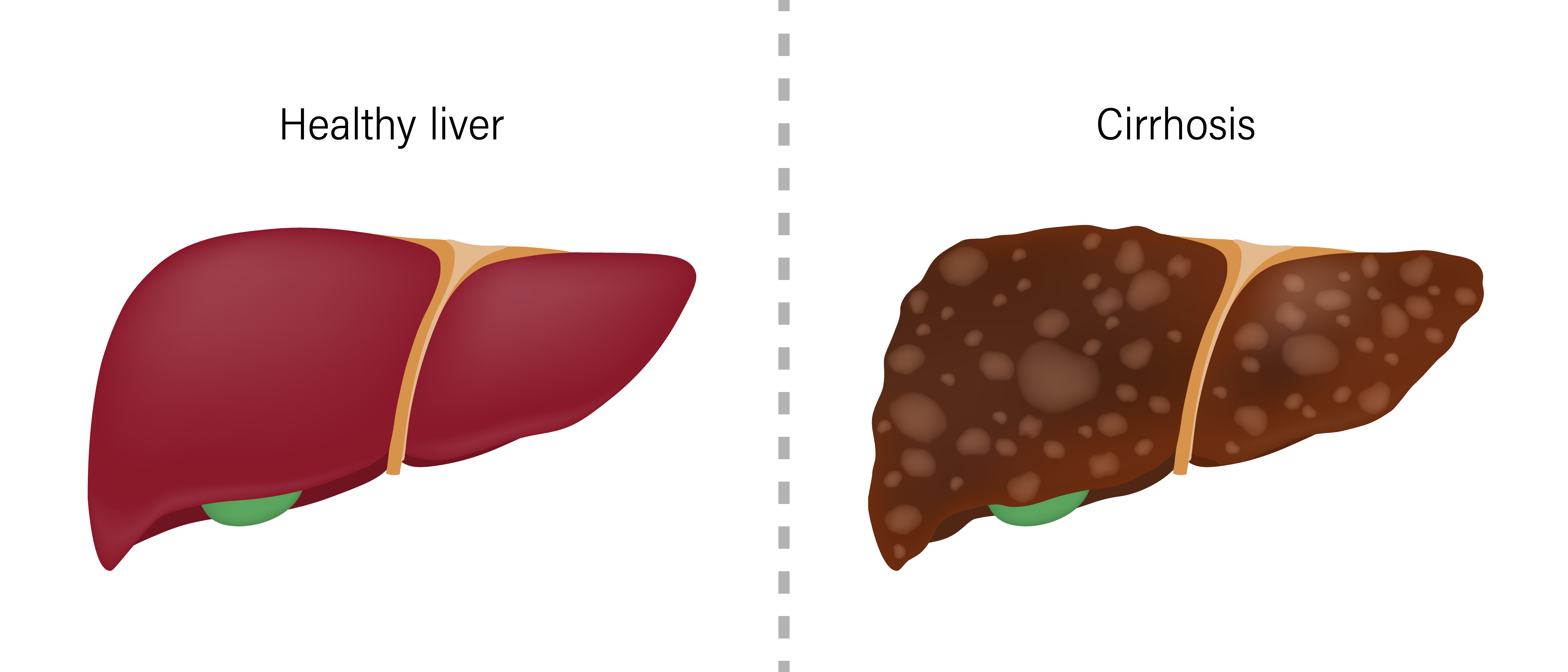 Liver Cirrhosis Dubai Hepatology Clinic
